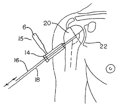 Shoulder Patent.jpg